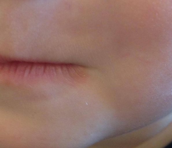 child's healed lip