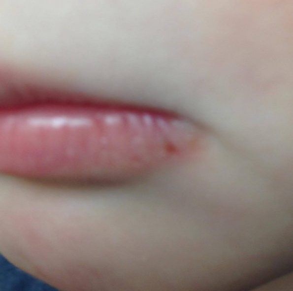 childs cracked lip