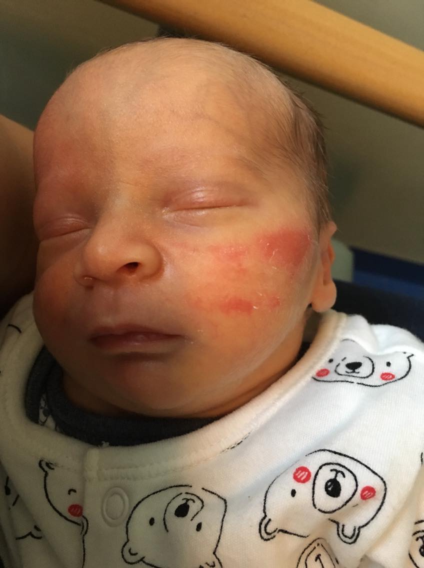marks on William's face from taking his feeding tube out