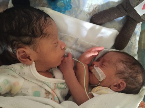 twins with feeding tubes