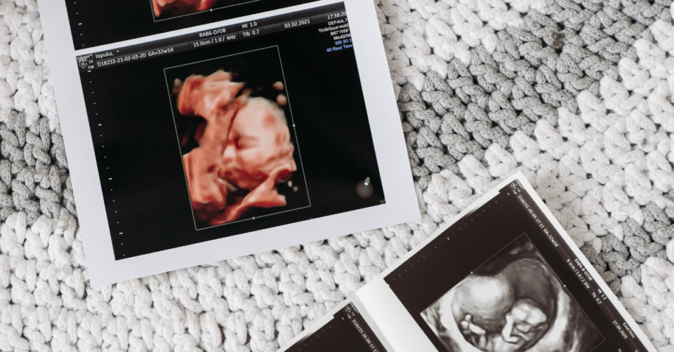3d ultrasound