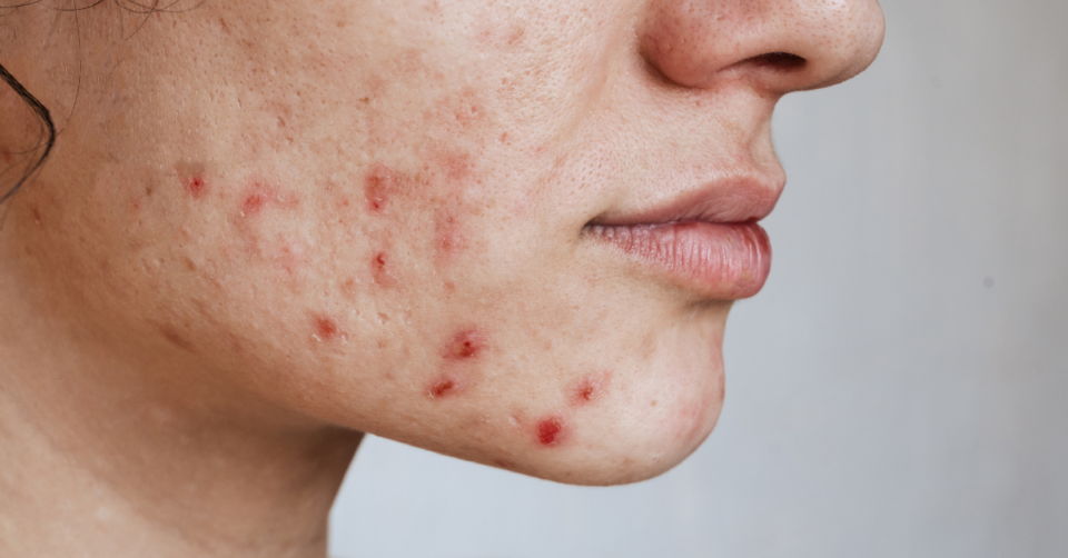 acne on a ladies face