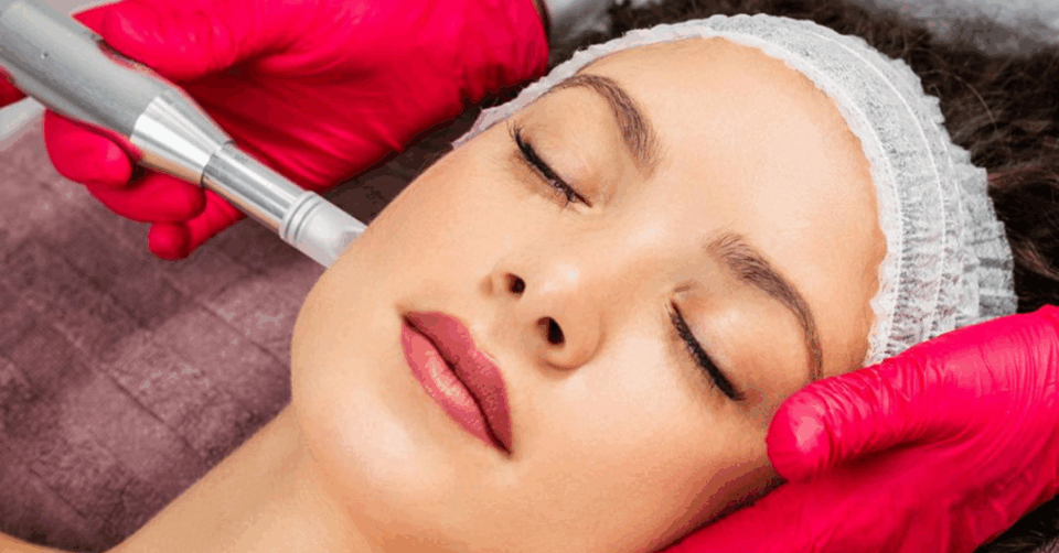 a lady getting microneedling