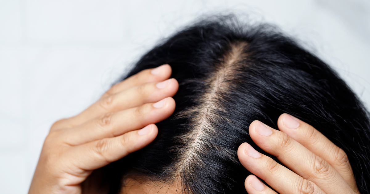 hair loss